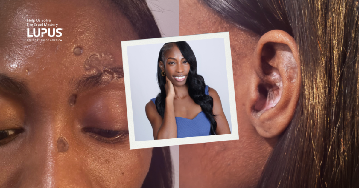 Personalized Lupus Skin Care Programs photo
