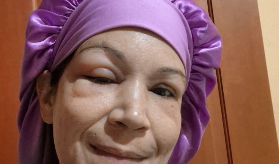 Alba C. - Diagnosed at age 25